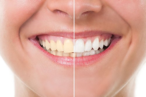 Blanqueador Dental Carbón Activado - IDEA NATURAL - 100% NATURAL - No OGM, Mejor que las tiras, Pasta de Dientes. Elimina las manchas y la placa (20g)